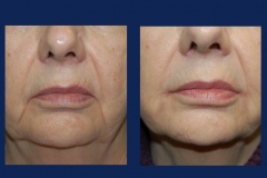 corner-of-the-mouth-lift-ba1