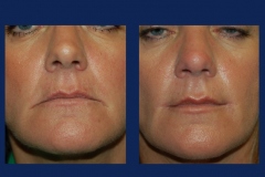 corner-of-the-mouth-lift-ba2