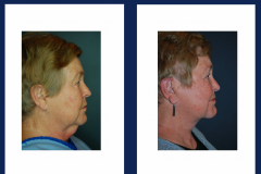 DirectFaceLift2