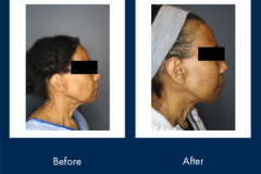 Facelift