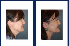 facelift-2-ba