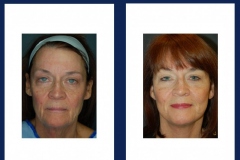 facelift-3-ba