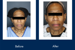 overstreet-facelift-updated
