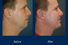 chin-implant-1-ba