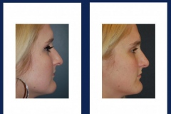 nose-2-ba