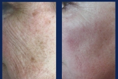 vi-chemical-peel-1