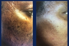vi-chemical-peel-2