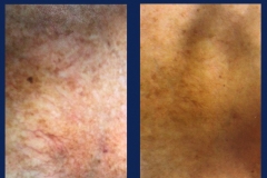 vi-chest-peel