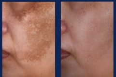 zo-3-step-chemical-peel-1