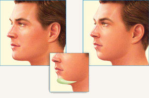 Chin Lifts - the Fastest Growing Trend in Plastic Surgery