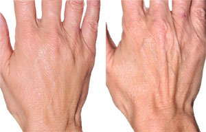 Are You in Need of Hand Rejuvenation?