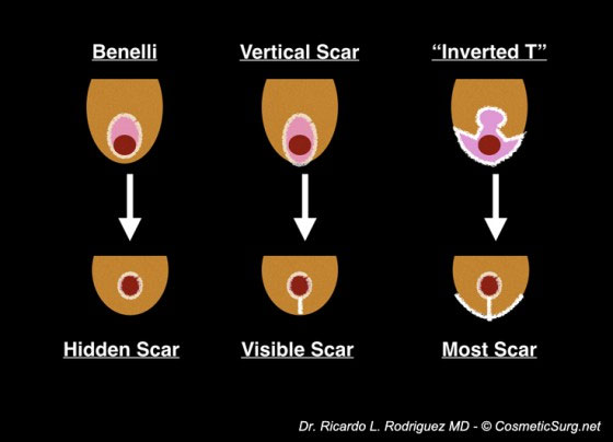 Breast Lift Procedures and Various Scar Types