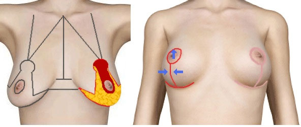 Breast Lift - The Basics