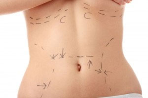 Tummy Tuck - The Basics