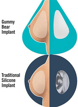 "Gummy Bear" Breast Implants