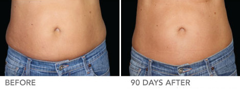 CoolSculpting® For Women